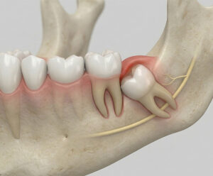 Muelas del juicio cerca del nervio: abordaje maxilofacial en casos complejos