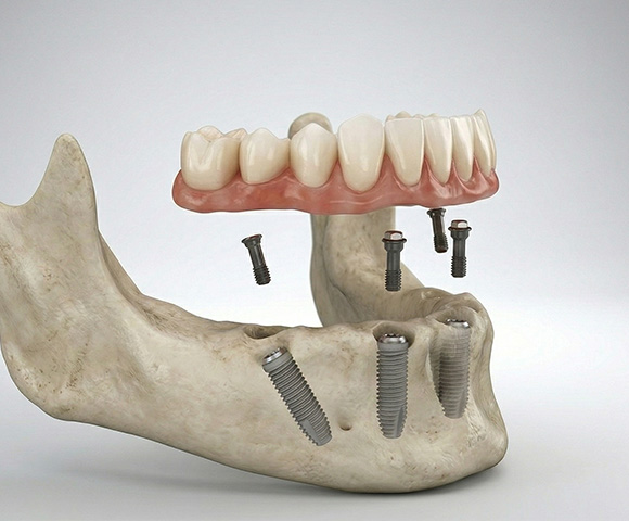 Ilustración médica de la técnica All on 4 mostrando cuatro implantes dentales y prótesis fija para rehabilitación oral en Monterrey.