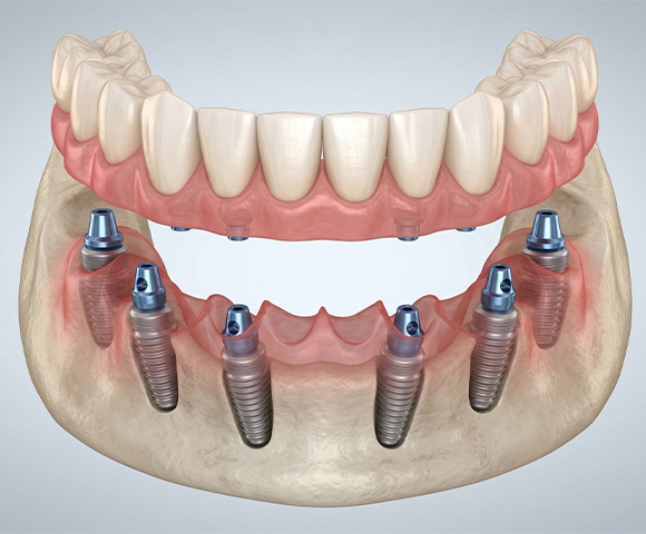Esquema anatómico 3D del procedimiento All on 6 con seis implantes y sobredentadura para restauración dental completa en Monterrey.