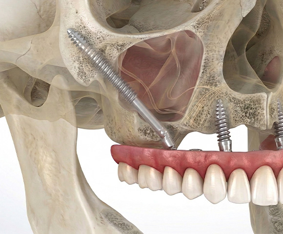 Modelo 3D de implantes cigomáticos anclados en el hueso del pómulo para pacientes con pérdida ósea severa en Monterrey.