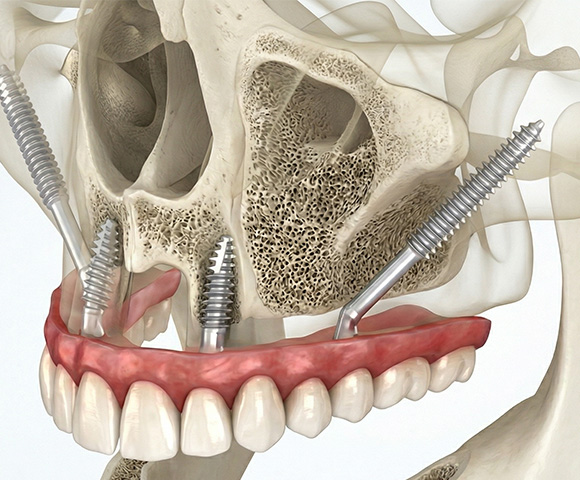 Ilustración médica 3D detallando la colocación de implantes pterigoideos en el maxilar posterior para rehabilitación compleja en Monterrey.