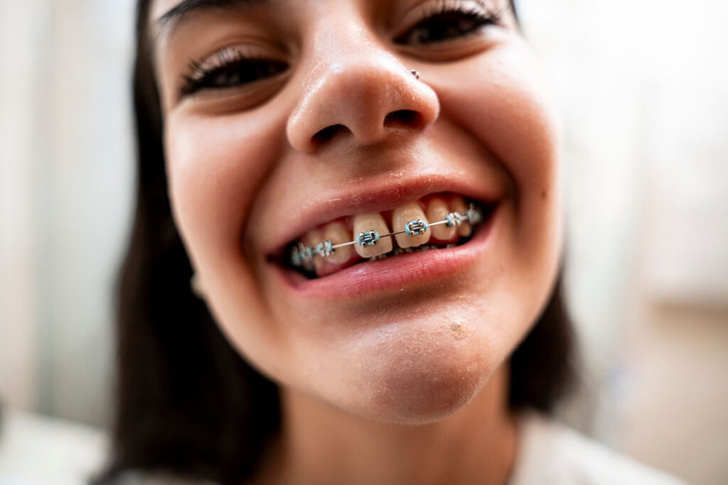 ¿Brackets antes de la cirugía ortognática? Entendiendo el proceso paso a paso