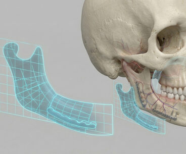 Modelo 3D de cráneo con placas de titanio demostrando la corrección de defectos óseos mediante cirugía facial reconstructiva en Monterrey.
