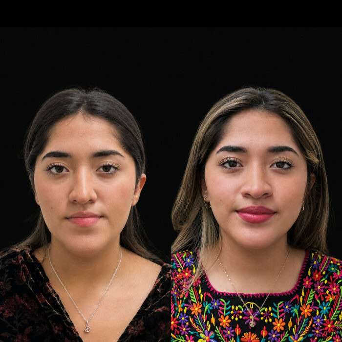 Cirugía Ortognática y Articulación Temporomandibular en Monterrey