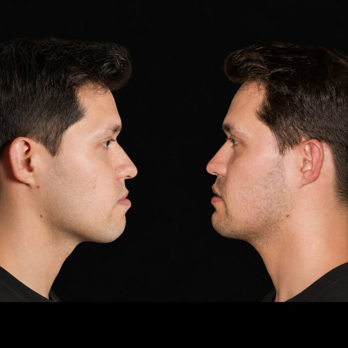 Perfil de Antes y después de cirugía ortognática masculina realizada por el Dr. Arquímedes Cantoran, cirujano maxilofacial en Monterrey.