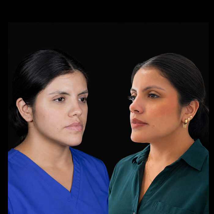 Antes y después de cirugía ortognática para mejorar perfil facial realizada por el Dr. Arquímedes Cantoran, cirujano maxilofacial en Monterrey.
