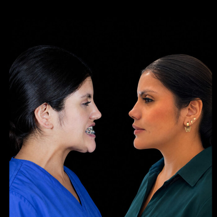 Perfil de Antes y después de cirugía ortognática para mejorar perfil facial realizada por el Dr. Arquímedes Cantoran, cirujano maxilofacial en Monterrey.