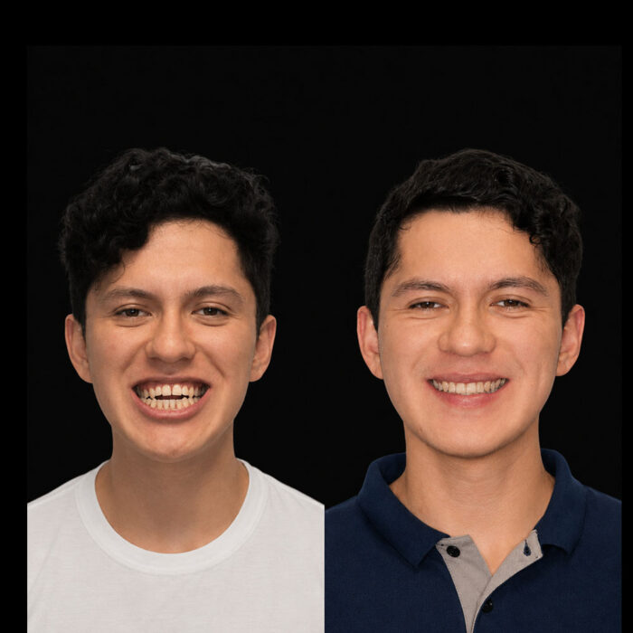 Antes y después de cirugía ortognática para corrección de mordida realizada por el Dr. Arquímedes Cantoran, cirujano maxilofacial en Monterrey.