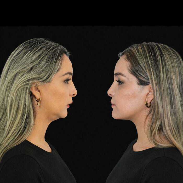 Resultado de cirugía ortognática en Monterrey, Dr. Artquimedes Cantoran