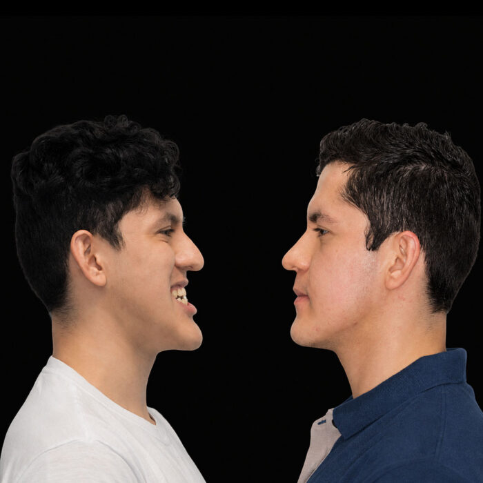 Perfil de Antes y después de cirugía ortognática para corrección de mordida realizada por el Dr. Arquímedes Cantoran, cirujano maxilofacial en Monterrey.