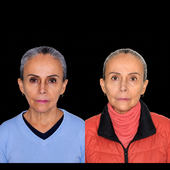 Antes y después de armonización facial full face realizada por el Dr. Arquímedes Cantoran, cirujano maxilofacial en Monterrey.
