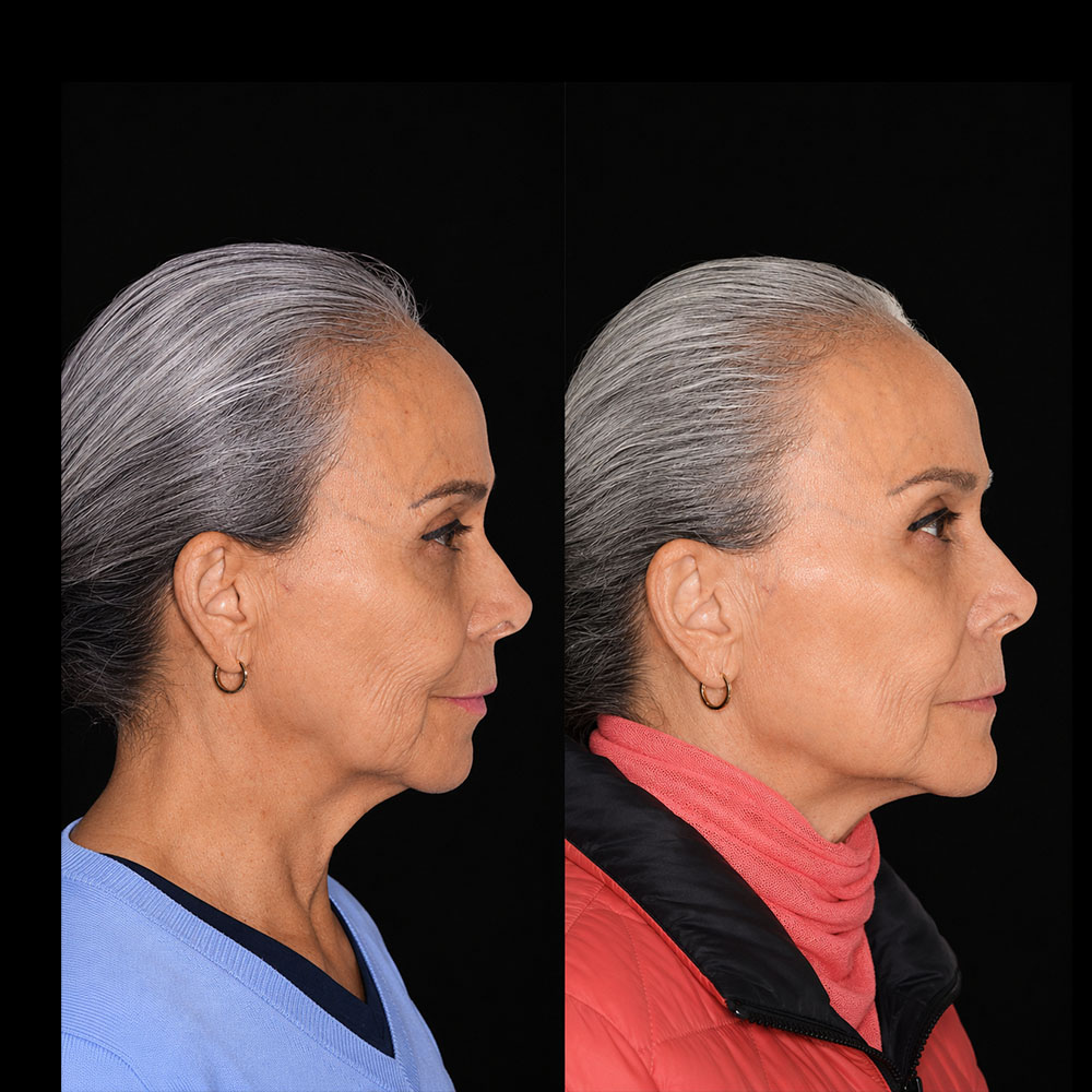 Perfil de Antes y después de armonización facial full face realizada por el Dr. Arquímedes Cantoran, cirujano maxilofacial en Monterrey.