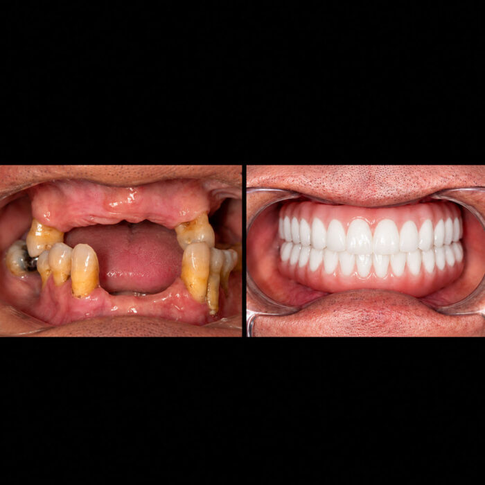 Antes y después de rehabilitación oral completa con implantes dentales realizada por el Dr. Arquímedes Cantoran, cirujano maxilofacial en Monterrey.