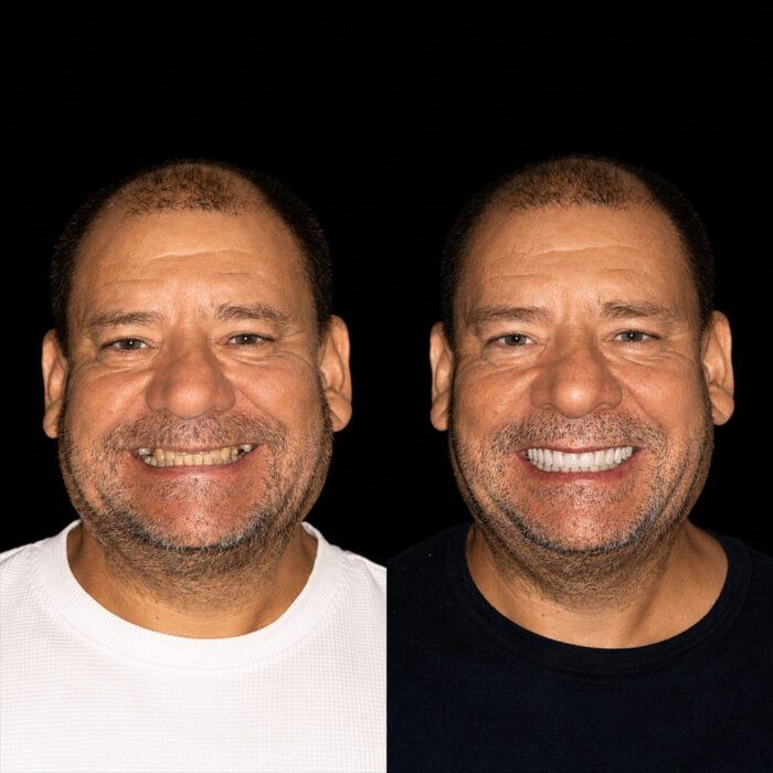 Antes y después de tratamiento All-on-4 con implantes dentales realizado por el Dr. Arquímedes Cantoran, cirujano maxilofacial en Monterrey.